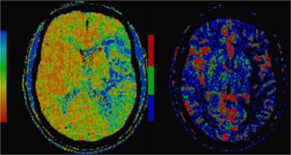 Imagen de TC (tomogafía computerizada) con un área de penumbra isquémica en el territorio de la cerebral media izquierda