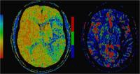 Imagen de TC (tomogaf�a computerizada) con un �rea de penumbra isqu�mica en el territorio de la cerebral media izquierda