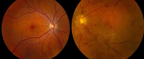 Imágenes de una retina sana --izquierda- y otra con retinopatía diabética (Fotos cedidas por NOVARTIS)
