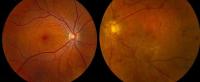 Imgenes de una retina sana --izquierda- y otra con retinopata diabtica (Fotos cedidas por NOVARTIS)